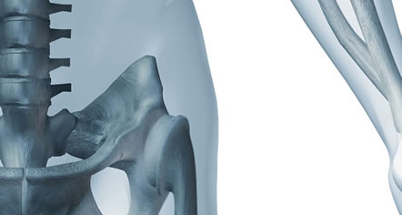 Anterior or Posterior Hip Replacement
